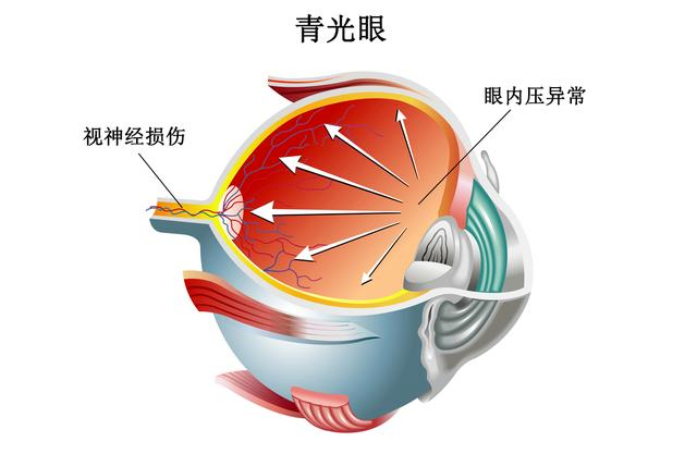 青光眼0 青光眼0